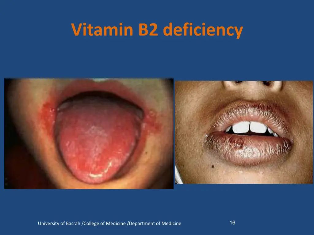 vitamin b2 deficiency 1