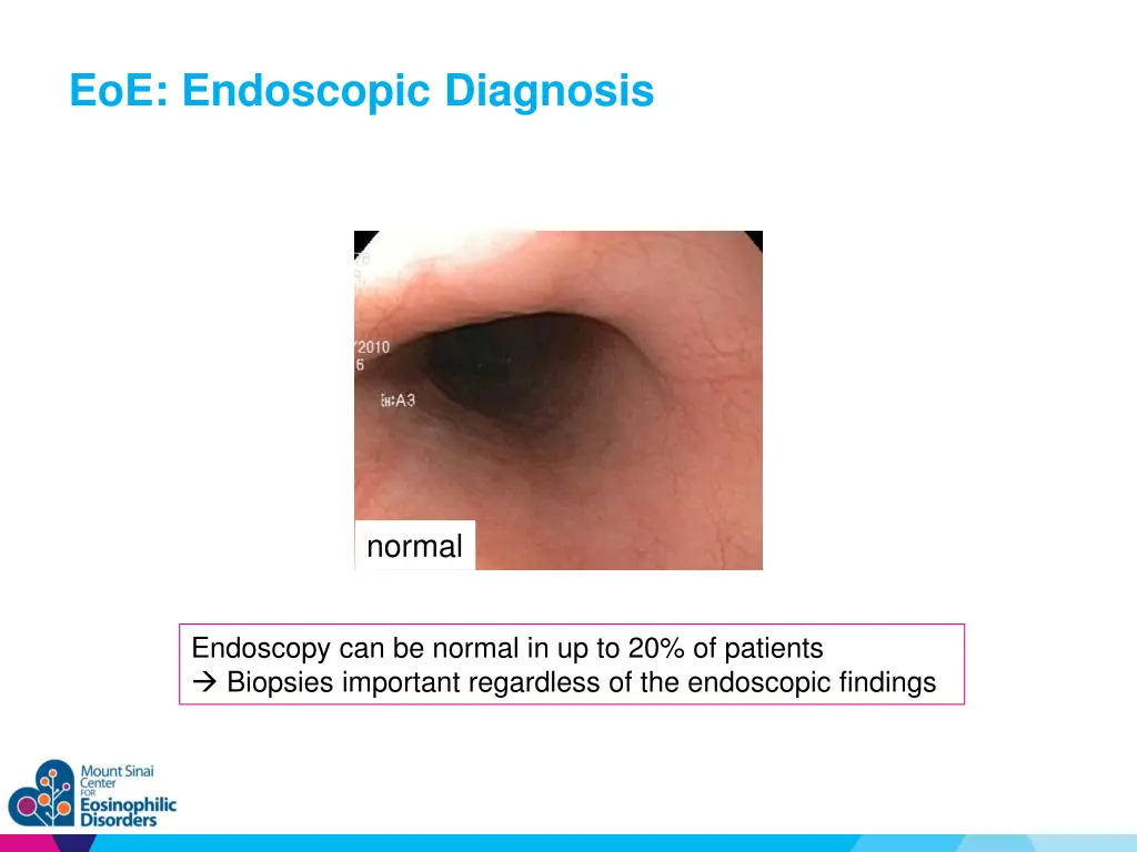 eoe endoscopic diagnosis 1