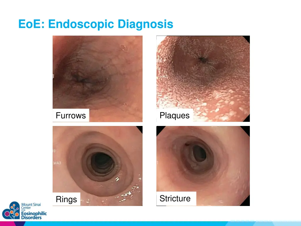 eoe endoscopic diagnosis