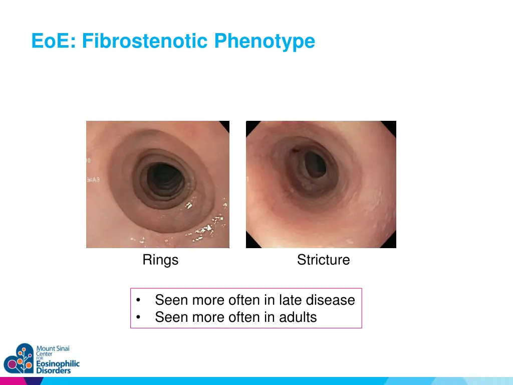 eoe fibrostenotic phenotype