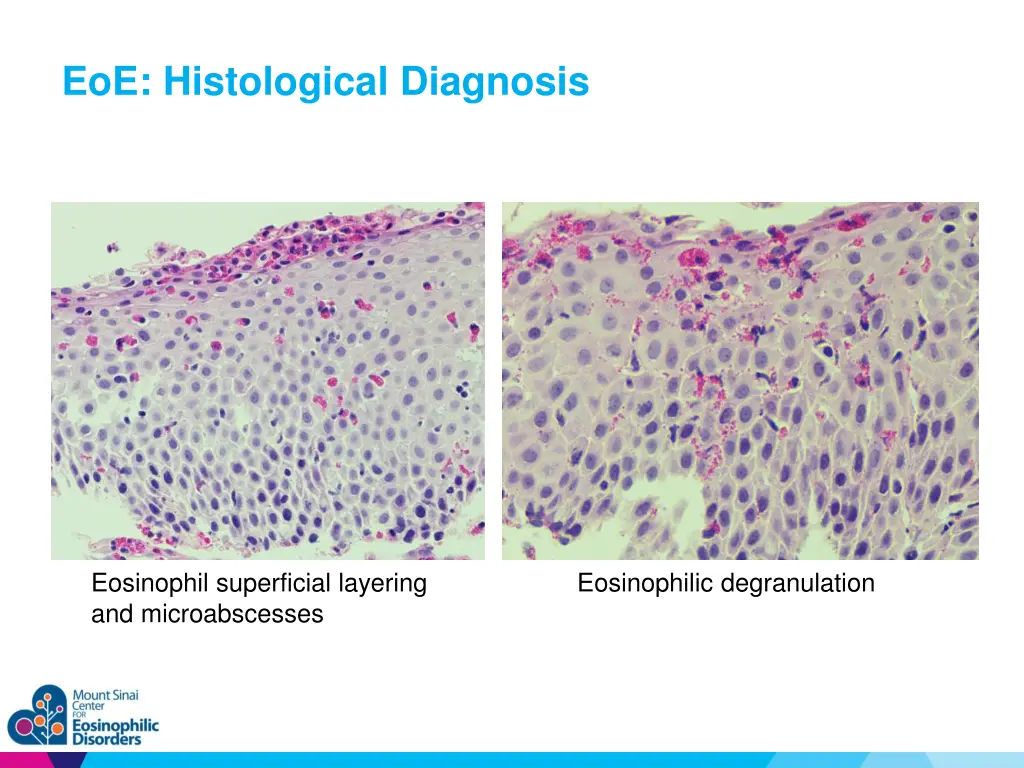 eoe histological diagnosis 1