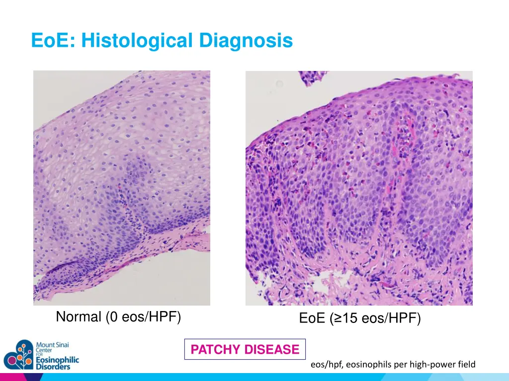 eoe histological diagnosis