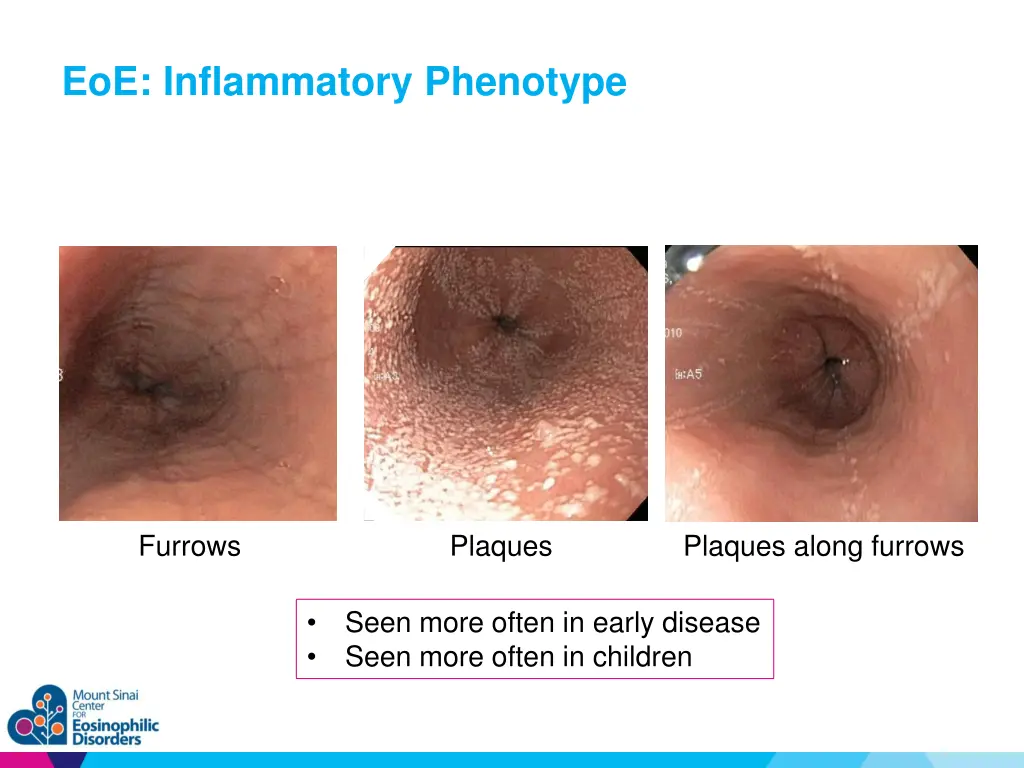 eoe inflammatory phenotype