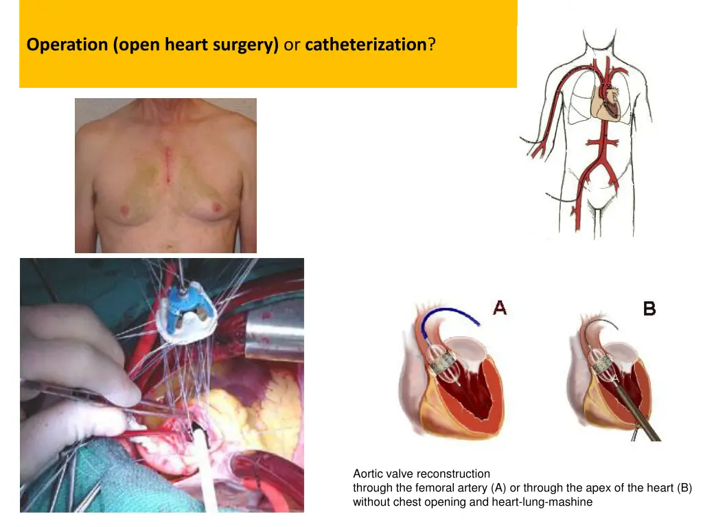 operation open heart surgery or catheterization