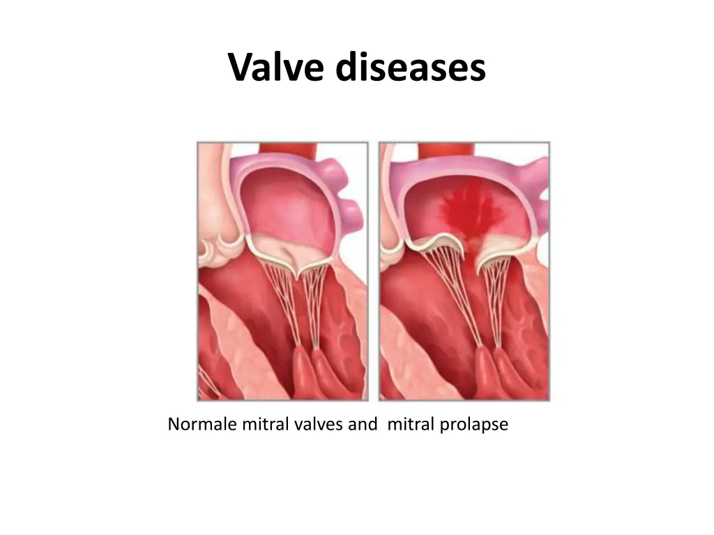 valve diseases 1