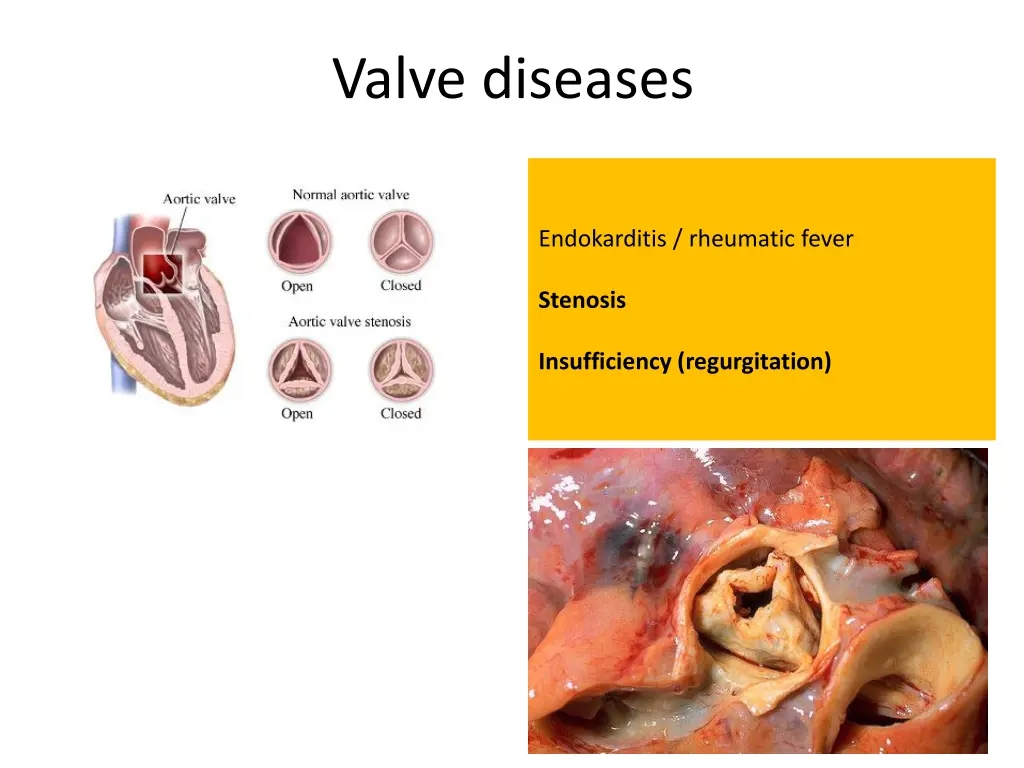 valve diseases