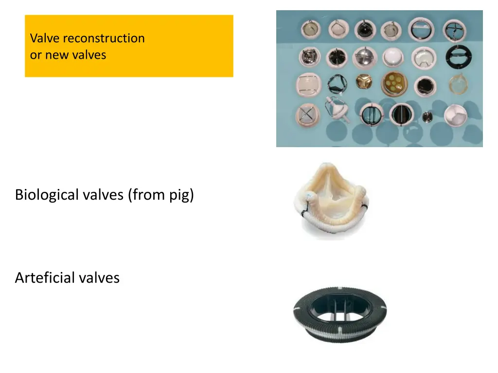 valve reconstruction or new valves