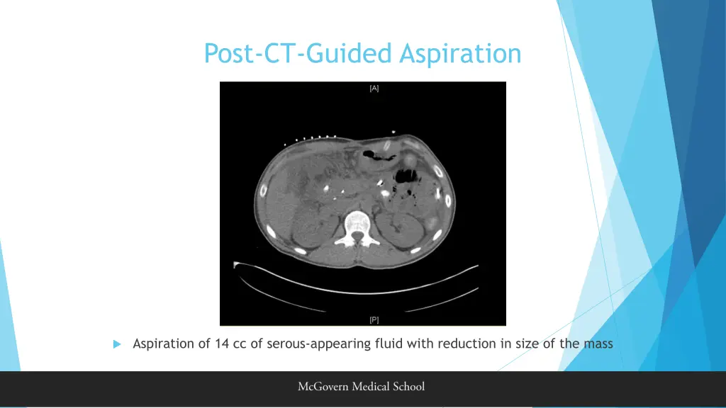 post ct guided aspiration