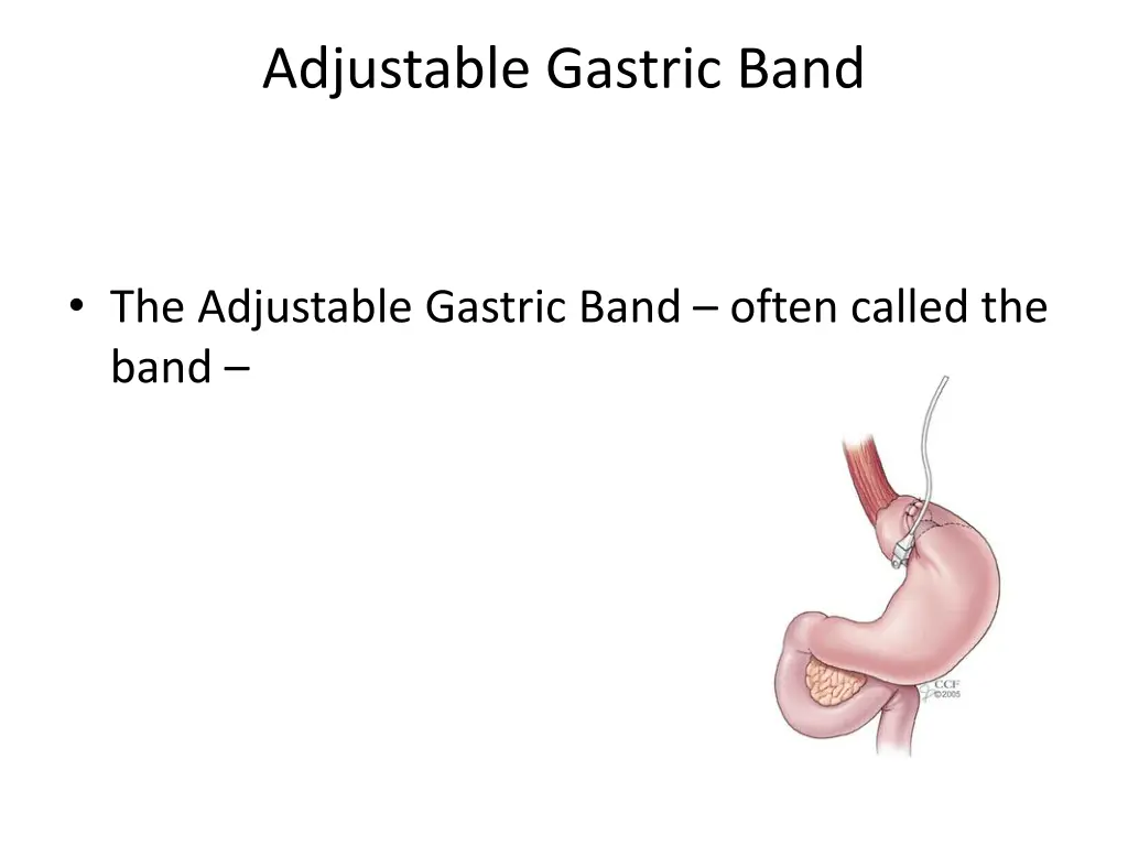 adjustable gastric band