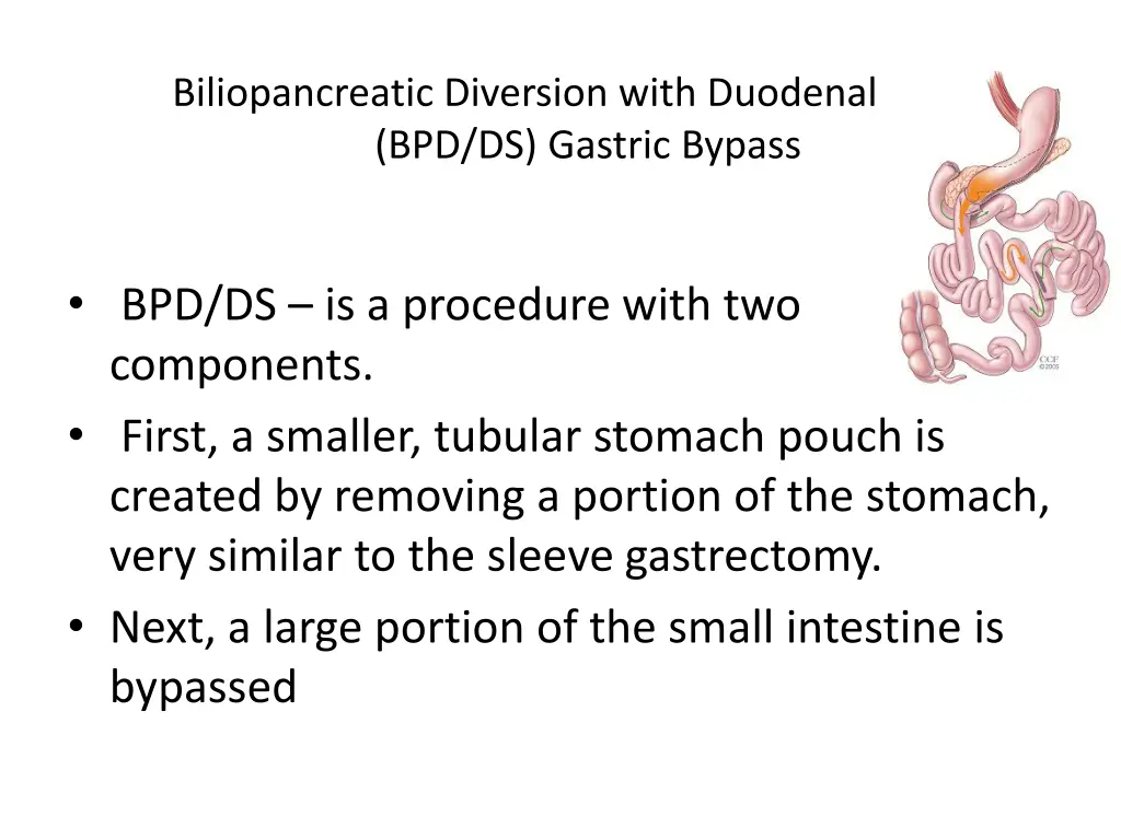 biliopancreatic diversion with duodenal switch