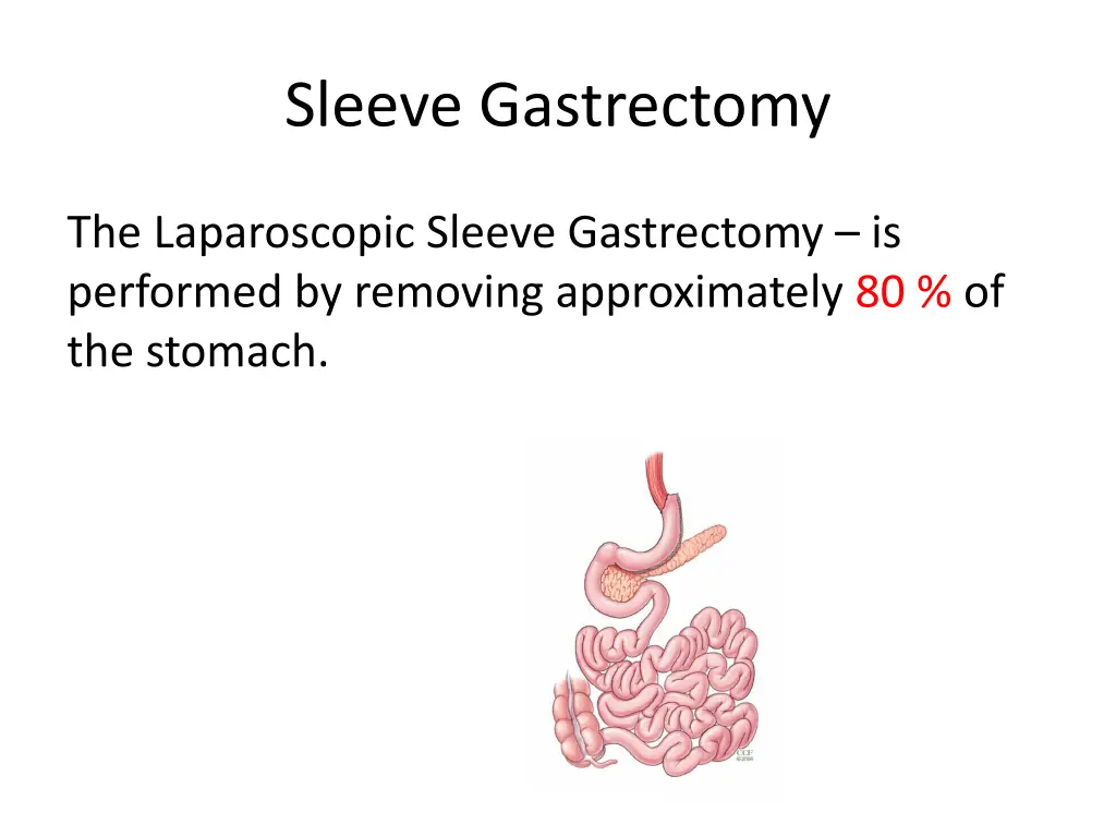 sleeve gastrectomy