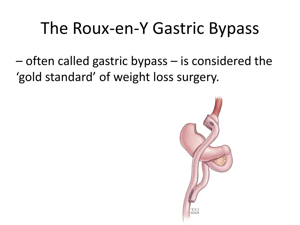 the roux en y gastric bypass