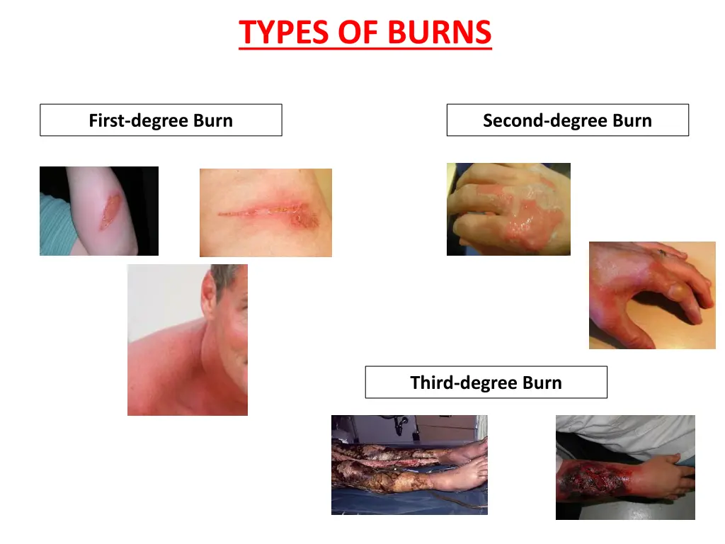 types of burns