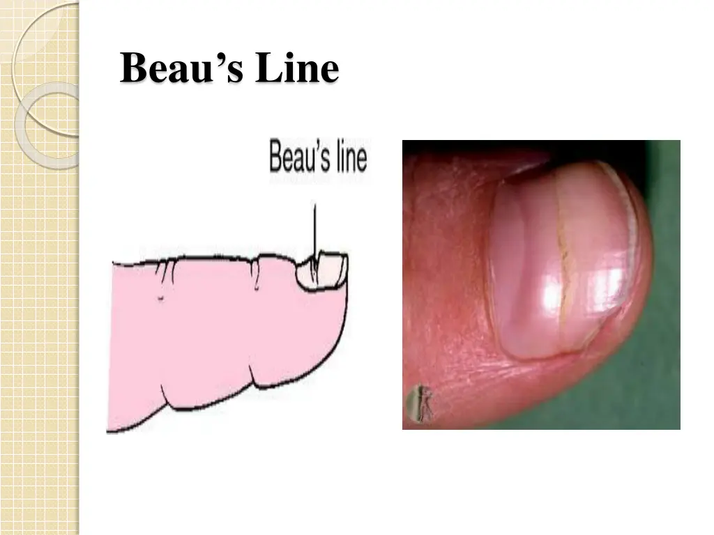 beau s line