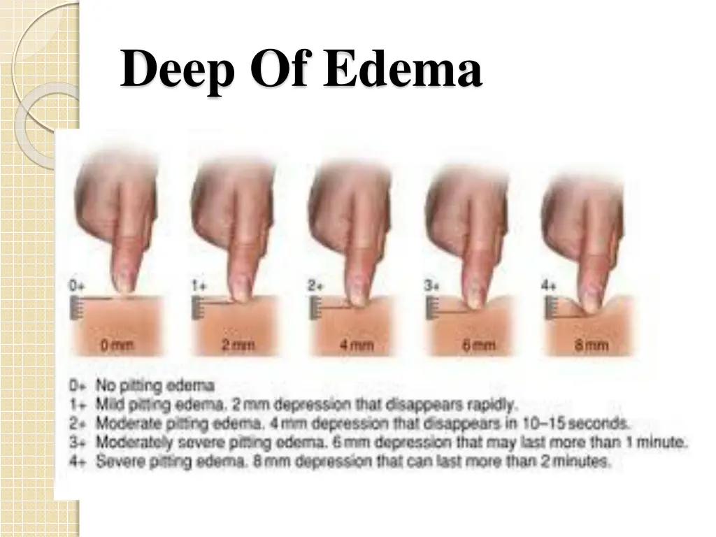 deep of edema