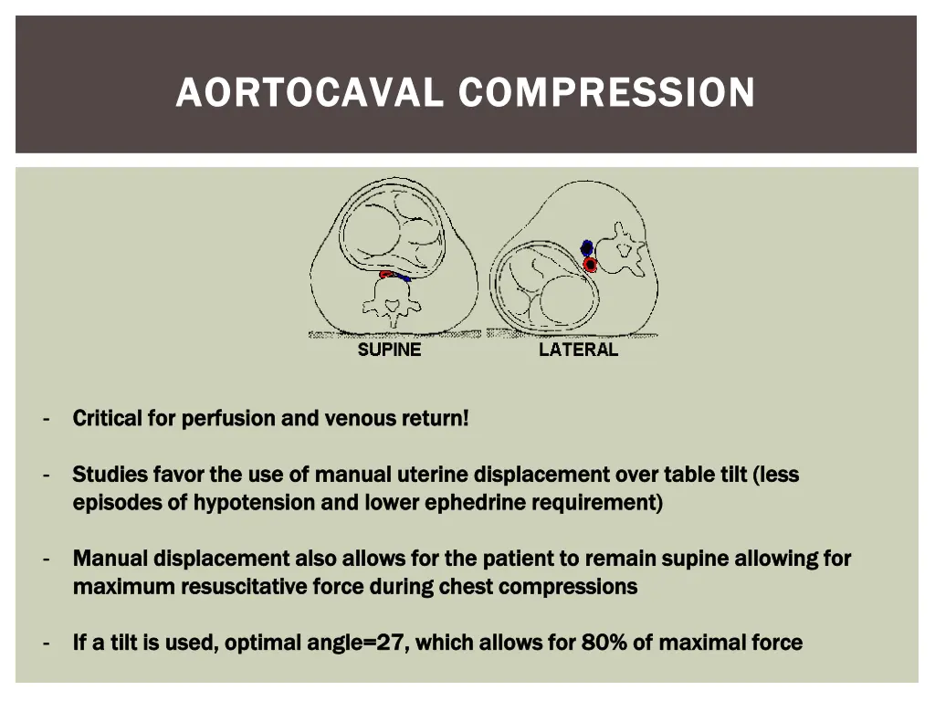 aortocaval compression aortocaval compression