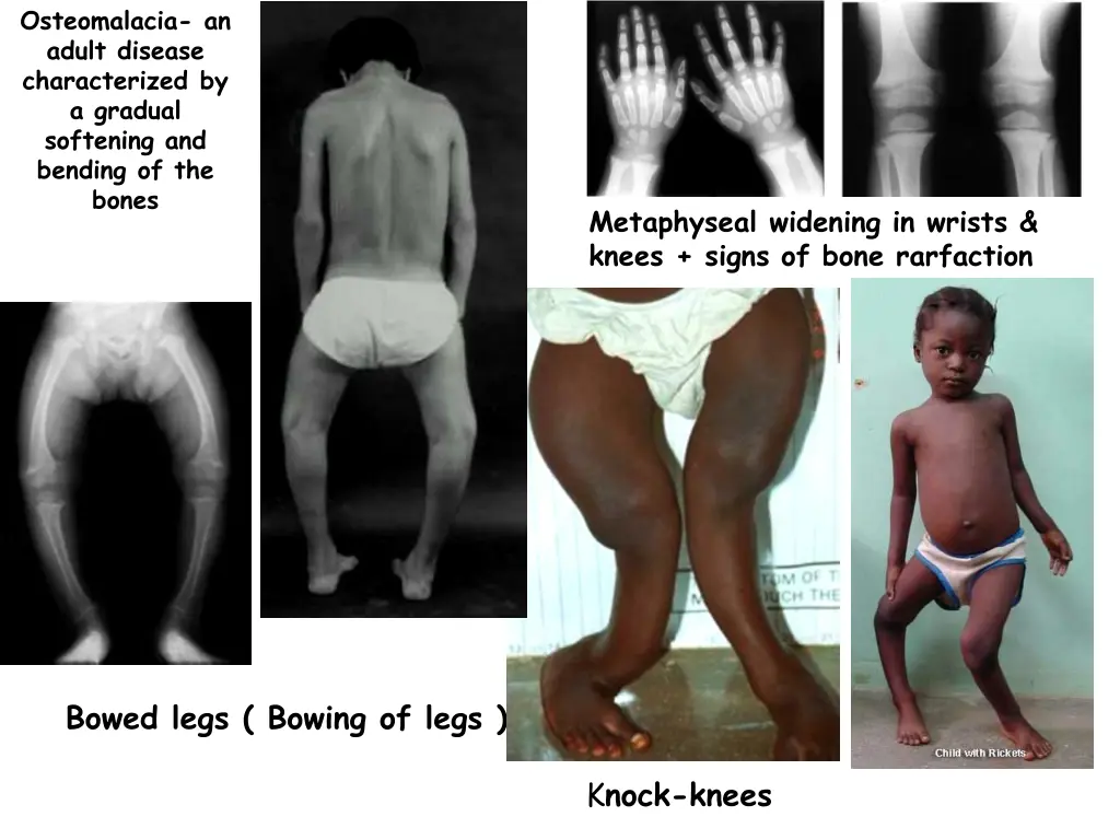 osteomalacia an adult disease characterized