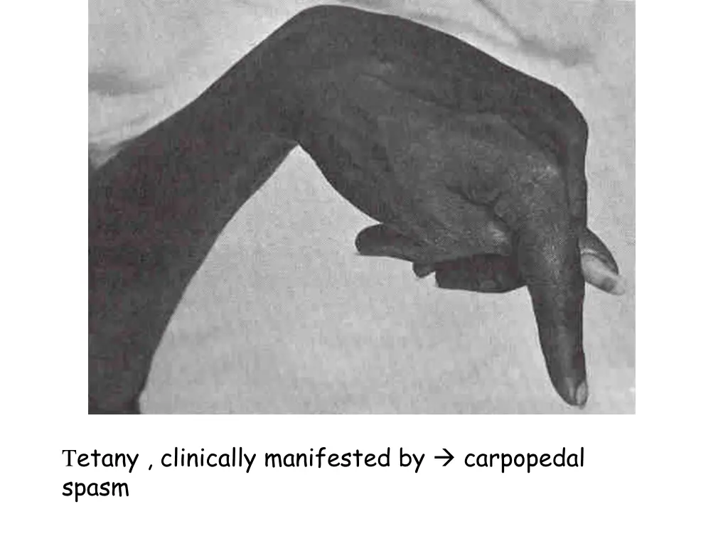 t etany clinically manifested by carpopedal spasm