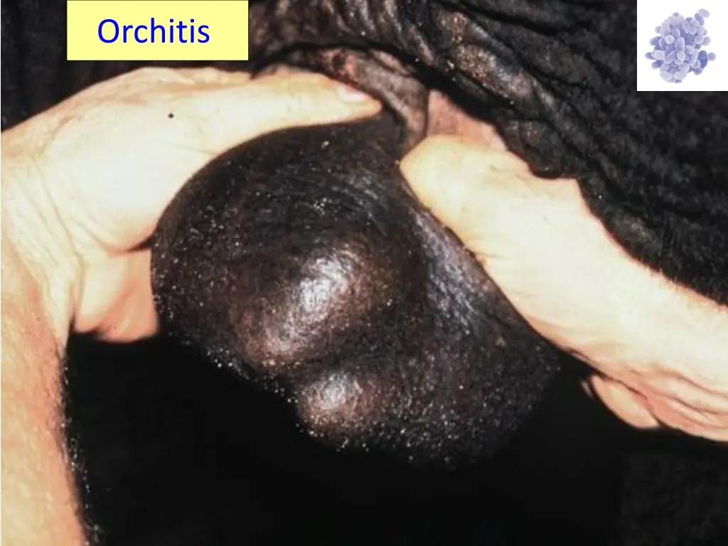 orchitis