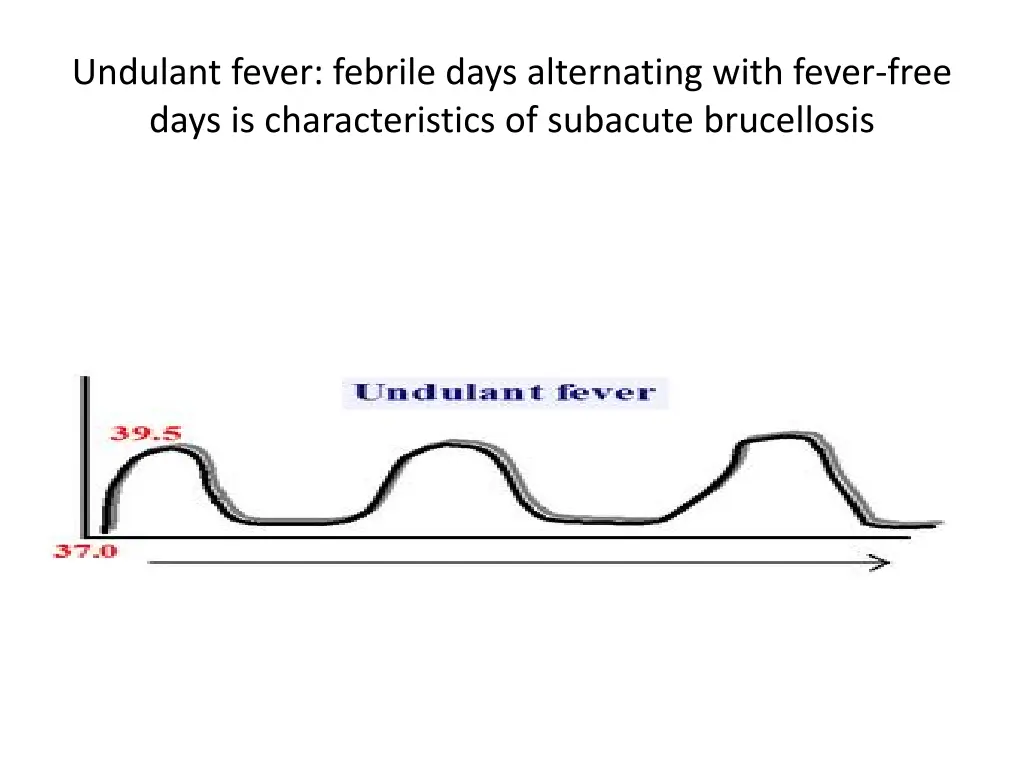 undulant fever febrile days alternating with