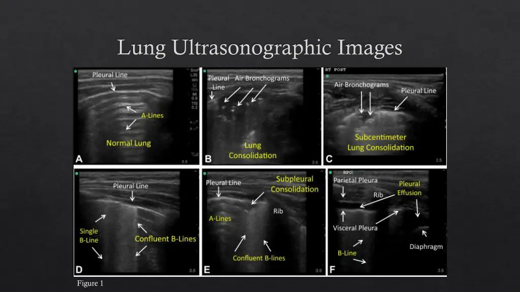 lung ultrasonographic images