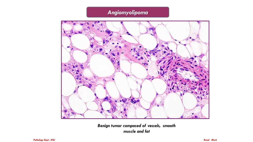 angiomyolipoma