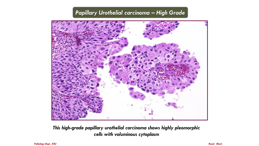 papillary urothelial carcinoma high grade