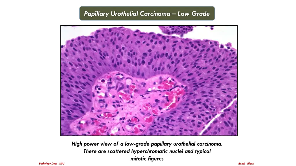 papillary urothelial carcinoma low grade 1