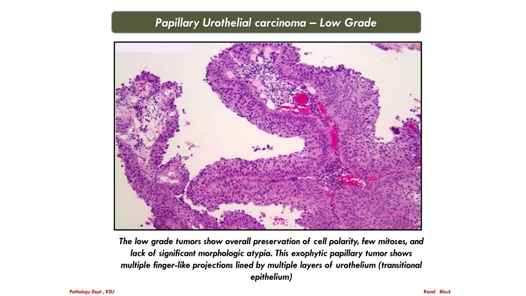 papillary urothelial carcinoma low grade