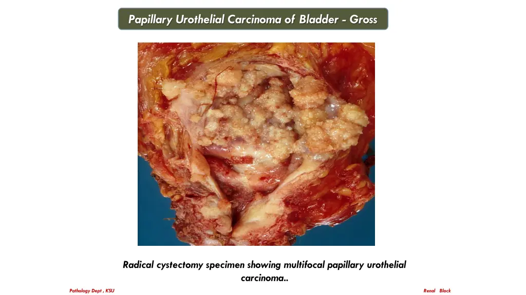 papillary urothelial carcinoma of bladder gross