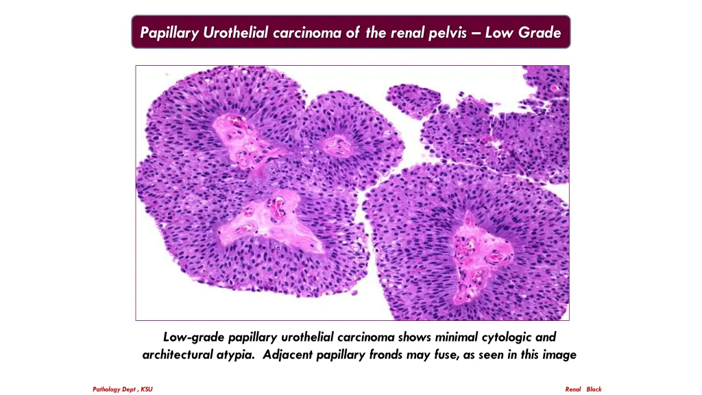 papillary urothelial carcinoma of the renal