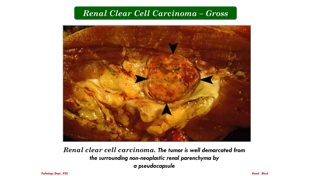 renal clear cell carcinoma gross