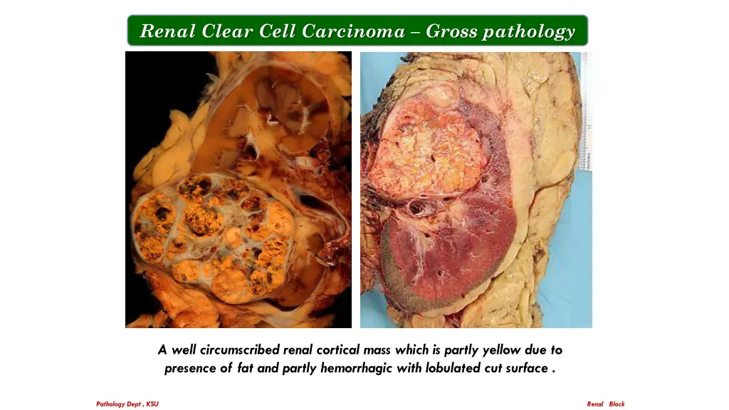 renal clear cell carcinoma gross pathology