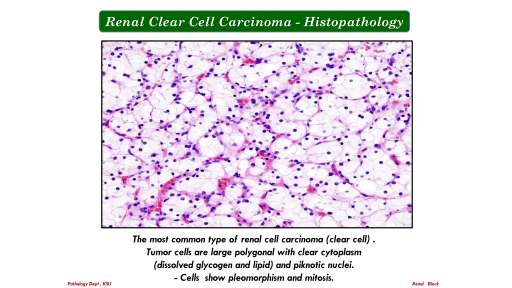 renal clear cell carcinoma histopathology 1