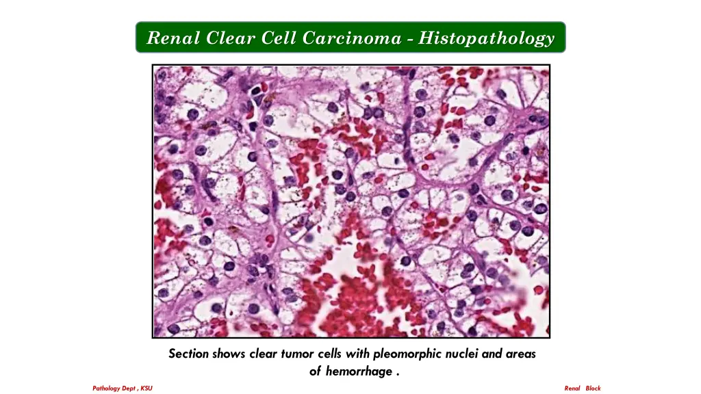 renal clear cell carcinoma histopathology 2