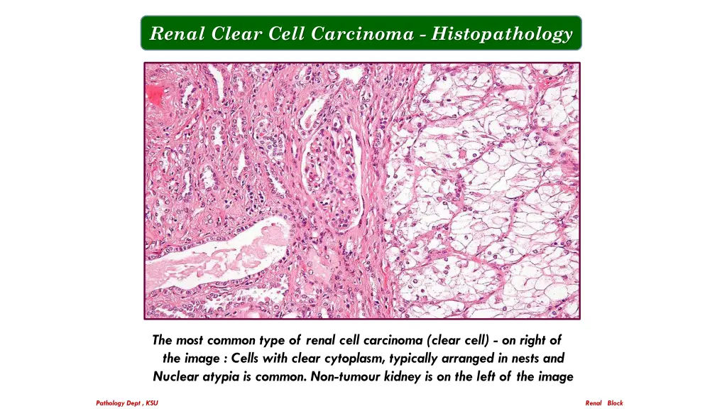 renal clear cell carcinoma histopathology