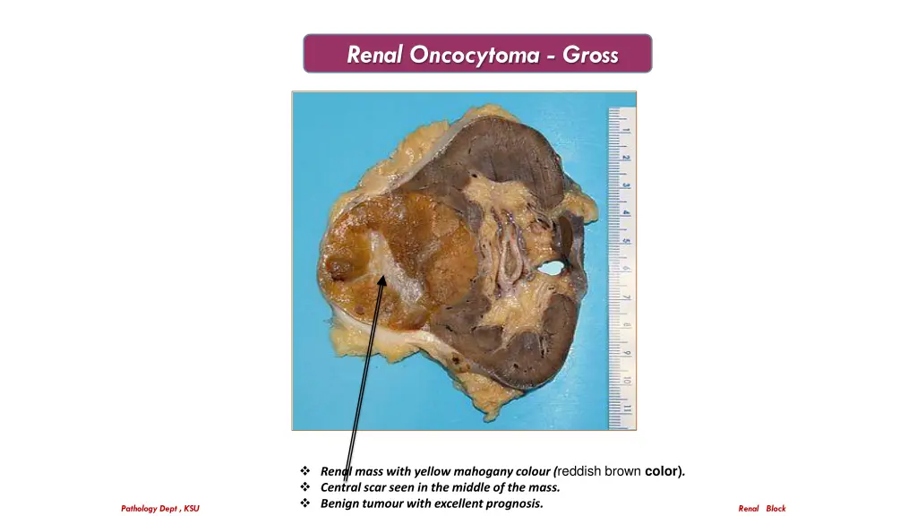 renal oncocytoma gross