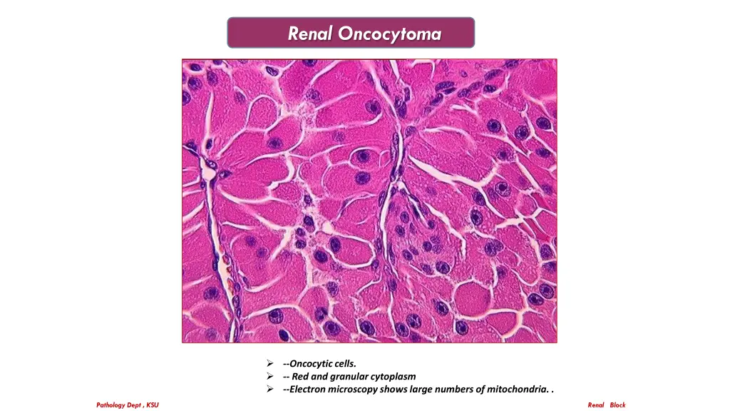 renal oncocytoma