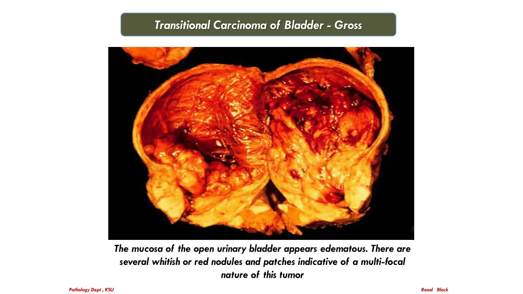 transitional carcinoma of bladder gross