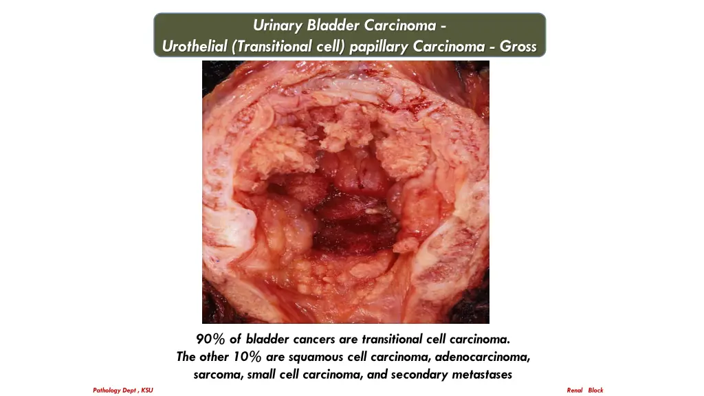 urinary bladder carcinoma urothelial transitional