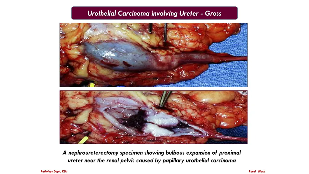 urothelial carcinoma involving ureter gross