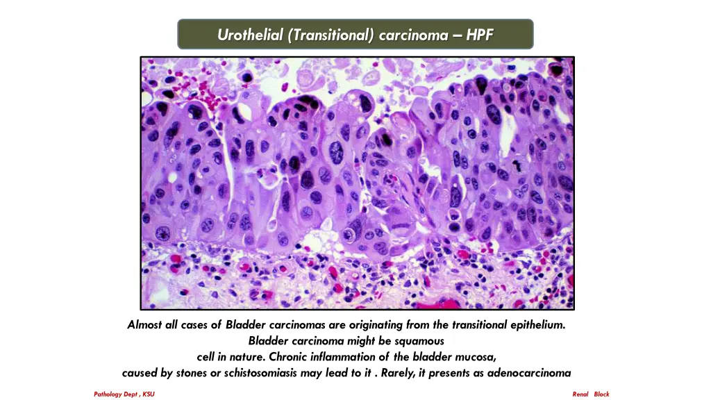 urothelial transitional carcinoma hpf