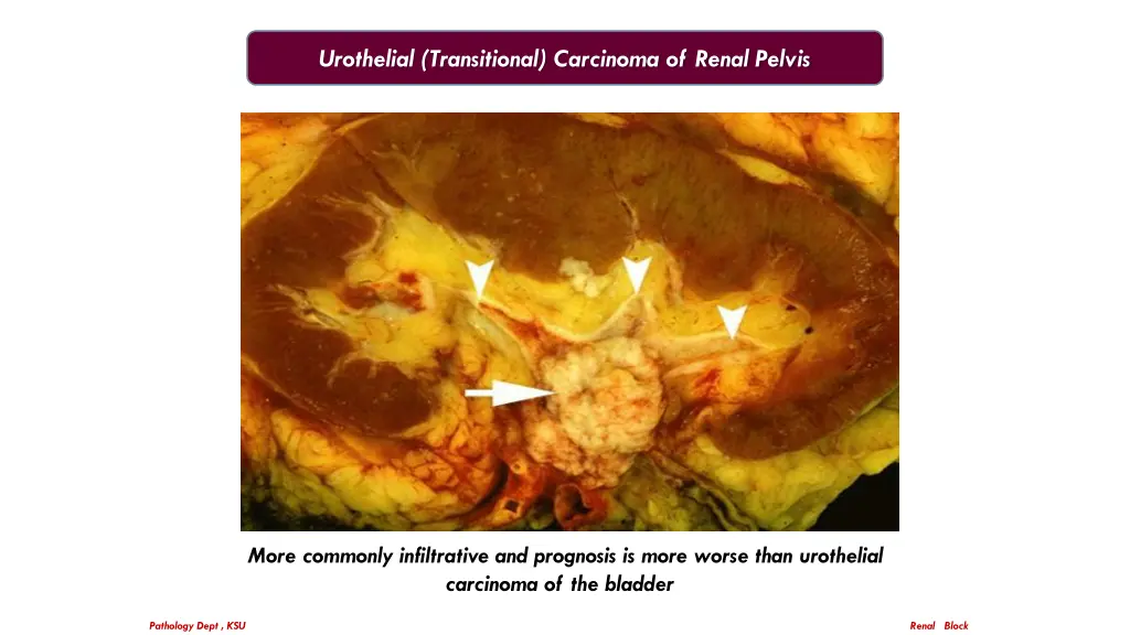 urothelial transitional carcinoma of renal pelvis