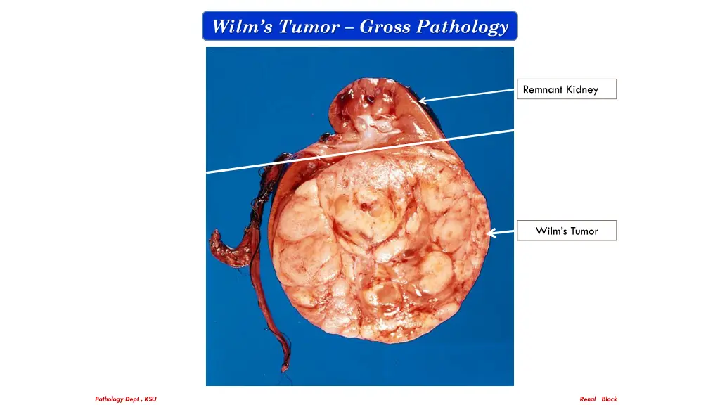 wilm s tumor gross pathology 1