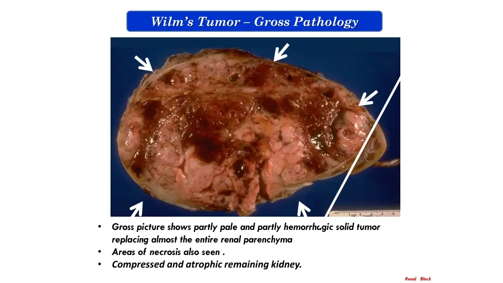 wilm s tumor gross pathology