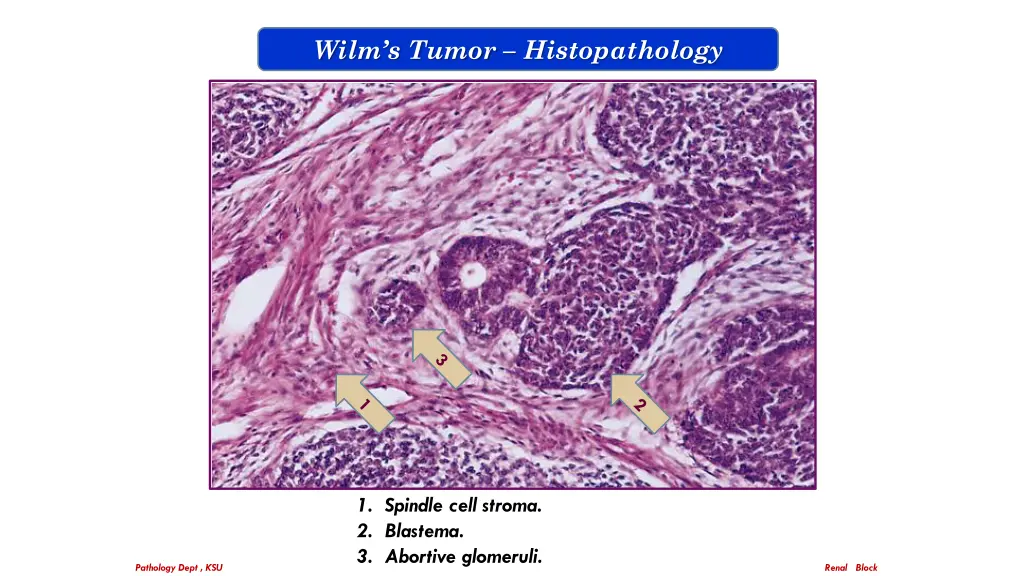 wilm s tumor histopathology 1