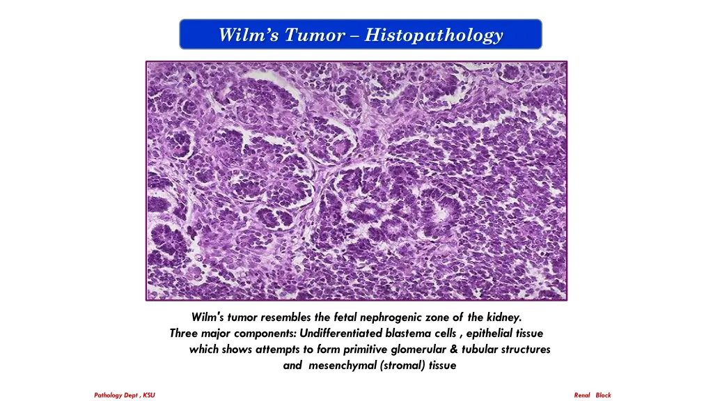 wilm s tumor histopathology 2