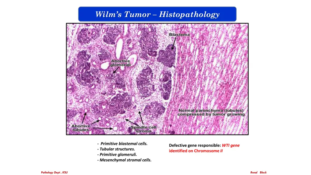 wilm s tumor histopathology