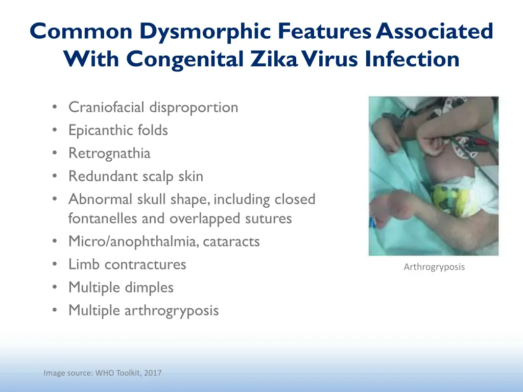 common dysmorphic features associated with