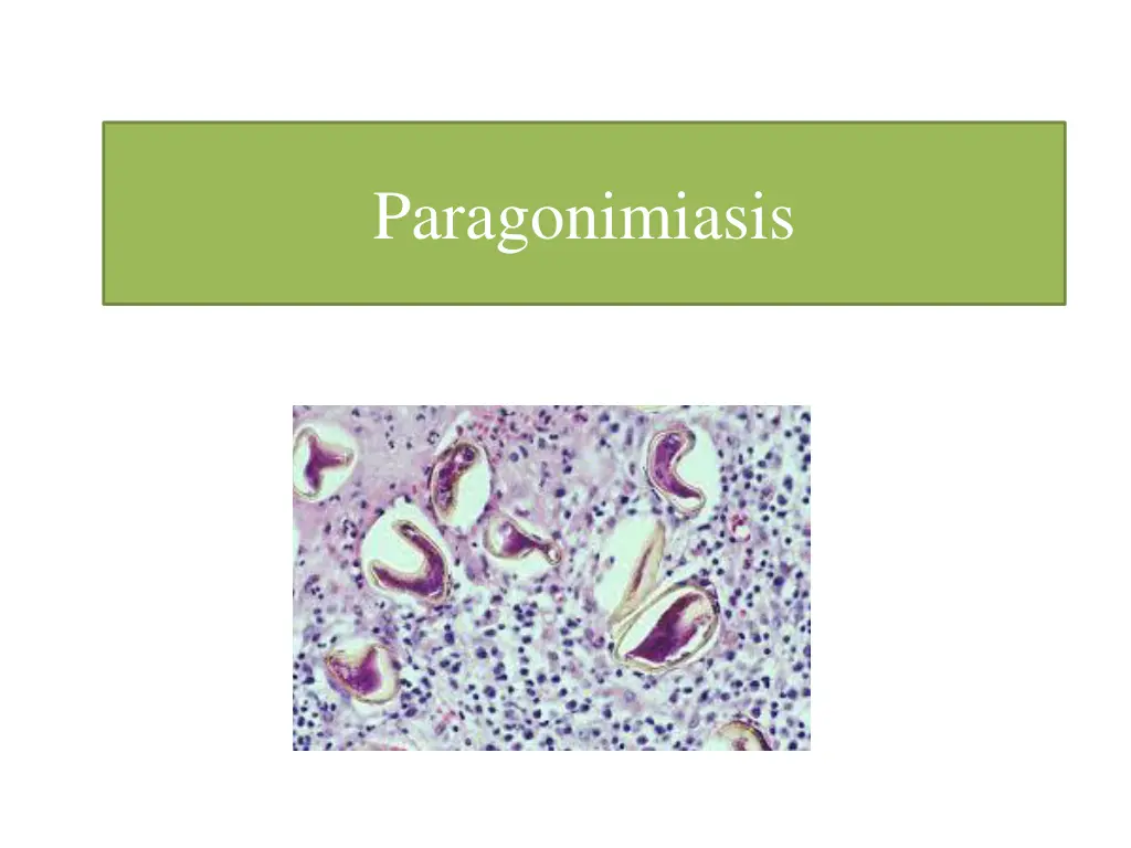 paragonimiasis